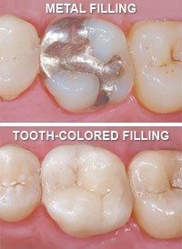 metal and tooth colored fillings