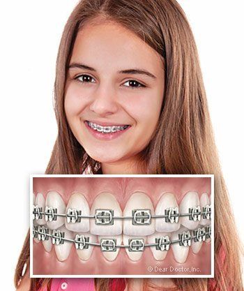 girl smiling wearing metal braces