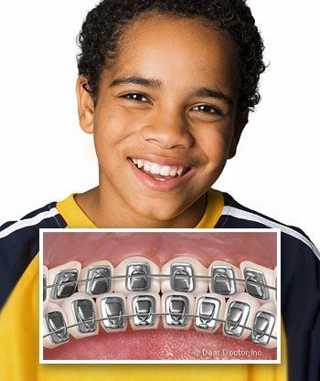 boy smiling wearing lingual braces
