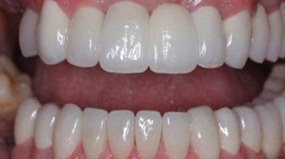 A close up of a person 's teeth with white teeth.