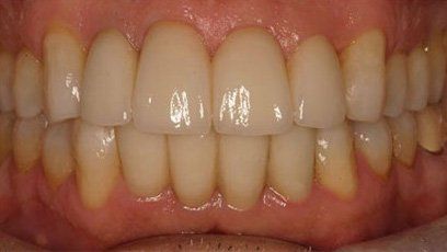 before and after sewell dental designs