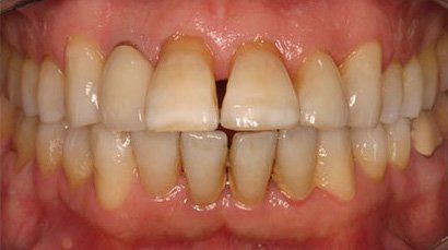 before and after sewell dental designs