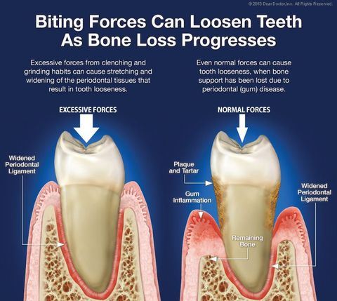 bone loss progression