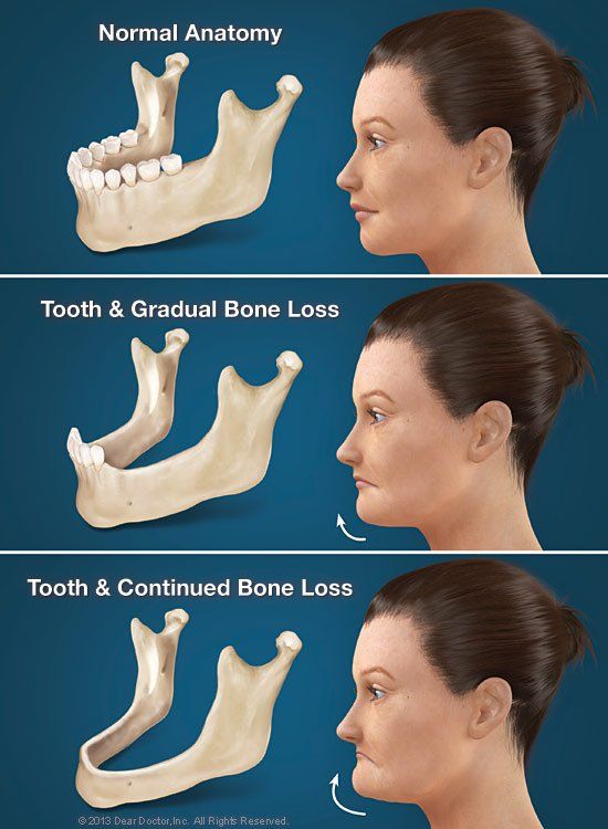 tooth loss anatomy