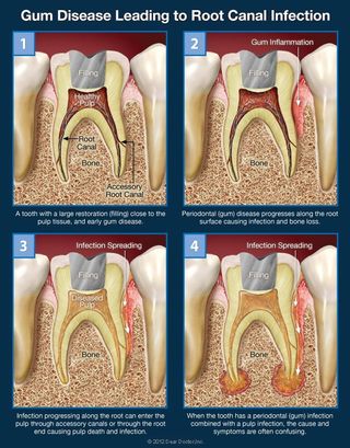 gum disease leading to root canal infection