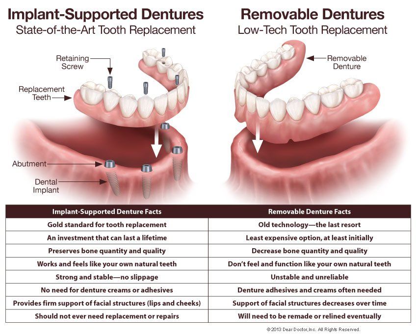 implant supported and removable dentures
