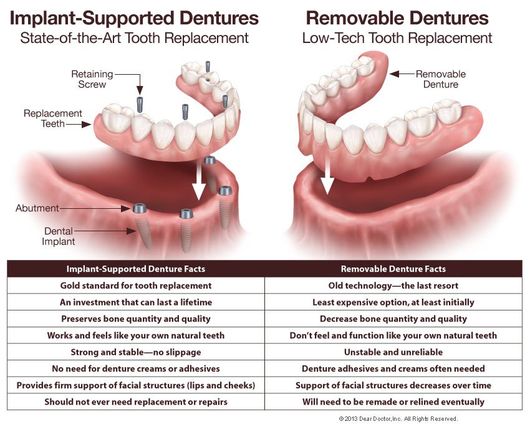 implant supported and removable dentures