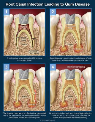root canal infection leading to gum disease
