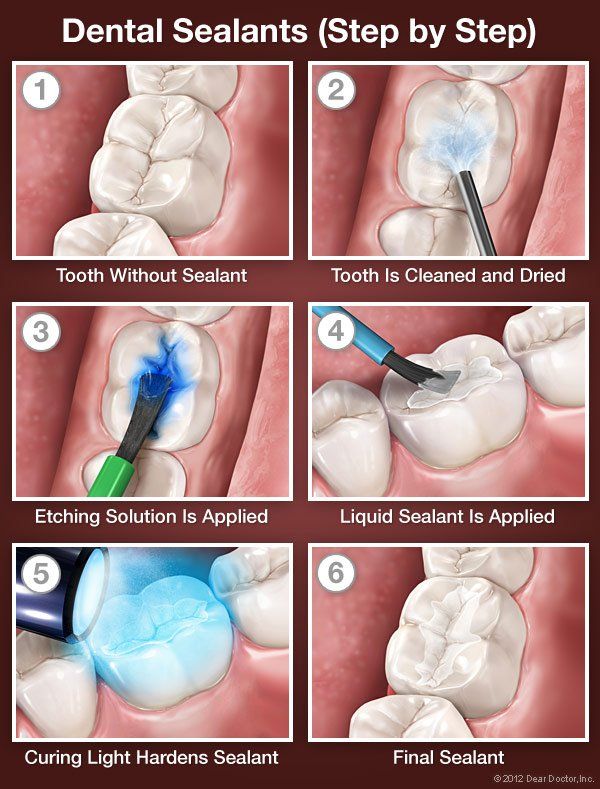 dental sealants step by step