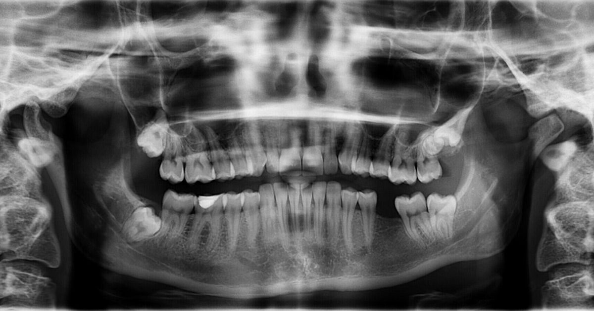 teeth replacement options