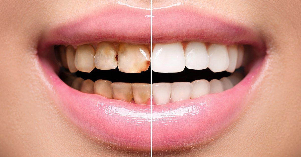 Porcelain Teeth Veneers