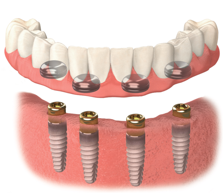 Implant Dentures — Denture Care in Berserker, QLD