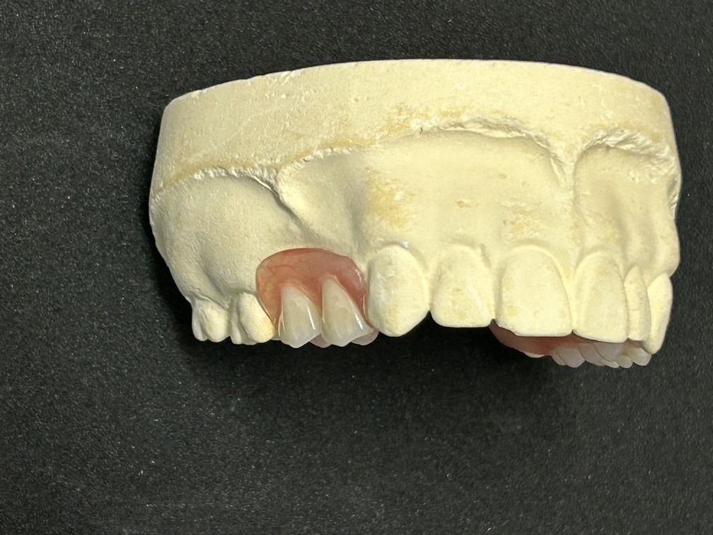 Denture Mold With Partial Dentures — Denture Care in Berserker, QLD