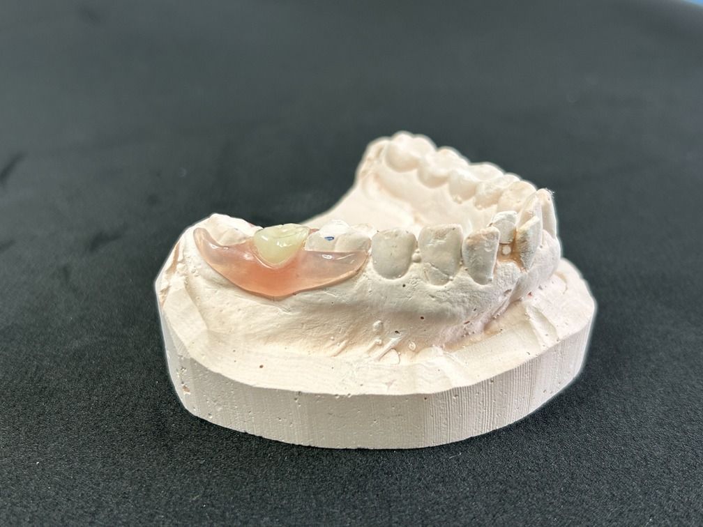 Denture Model — Denture Care in Berserker, QLD