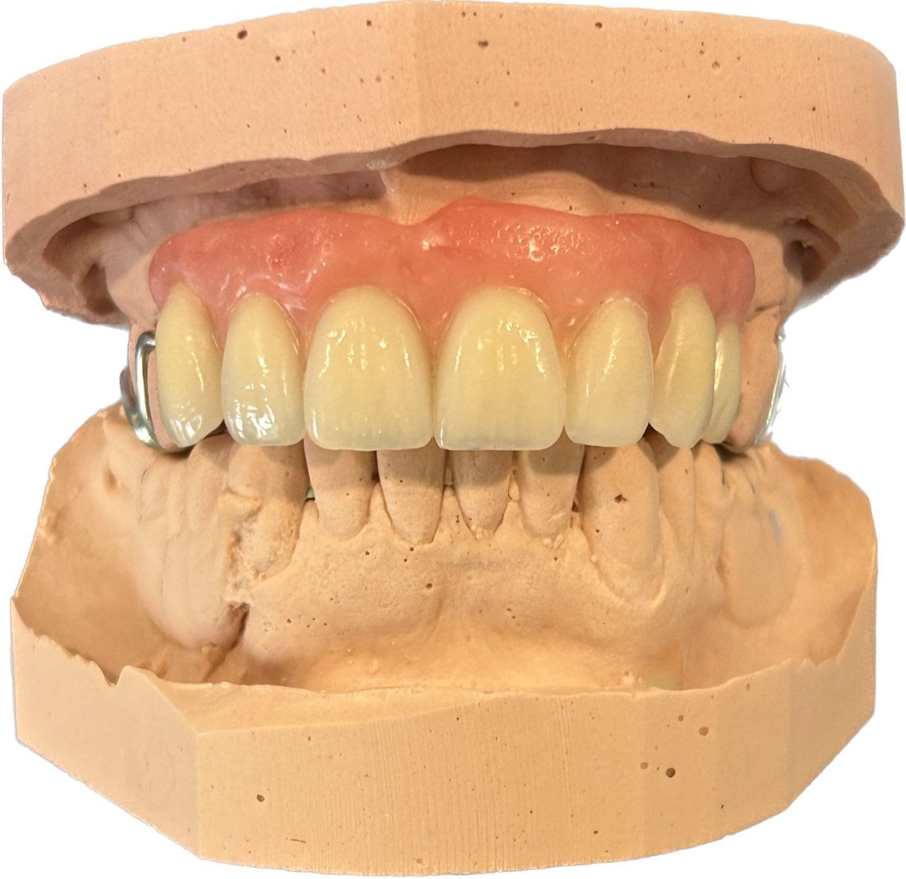 Partial Denture Set - Precise Dentures Rockhampton 