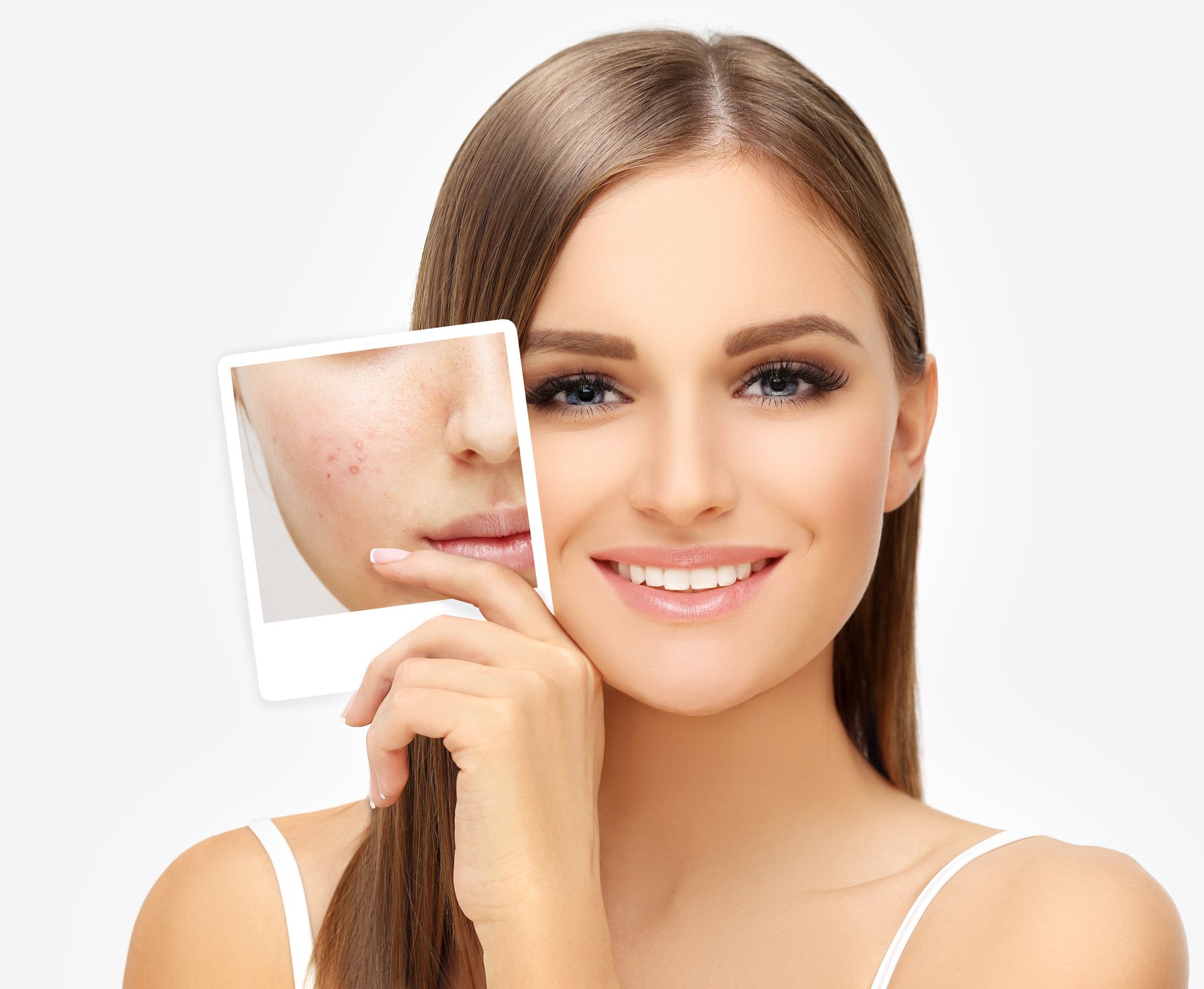 A woman is holding a picture of her face with acne.