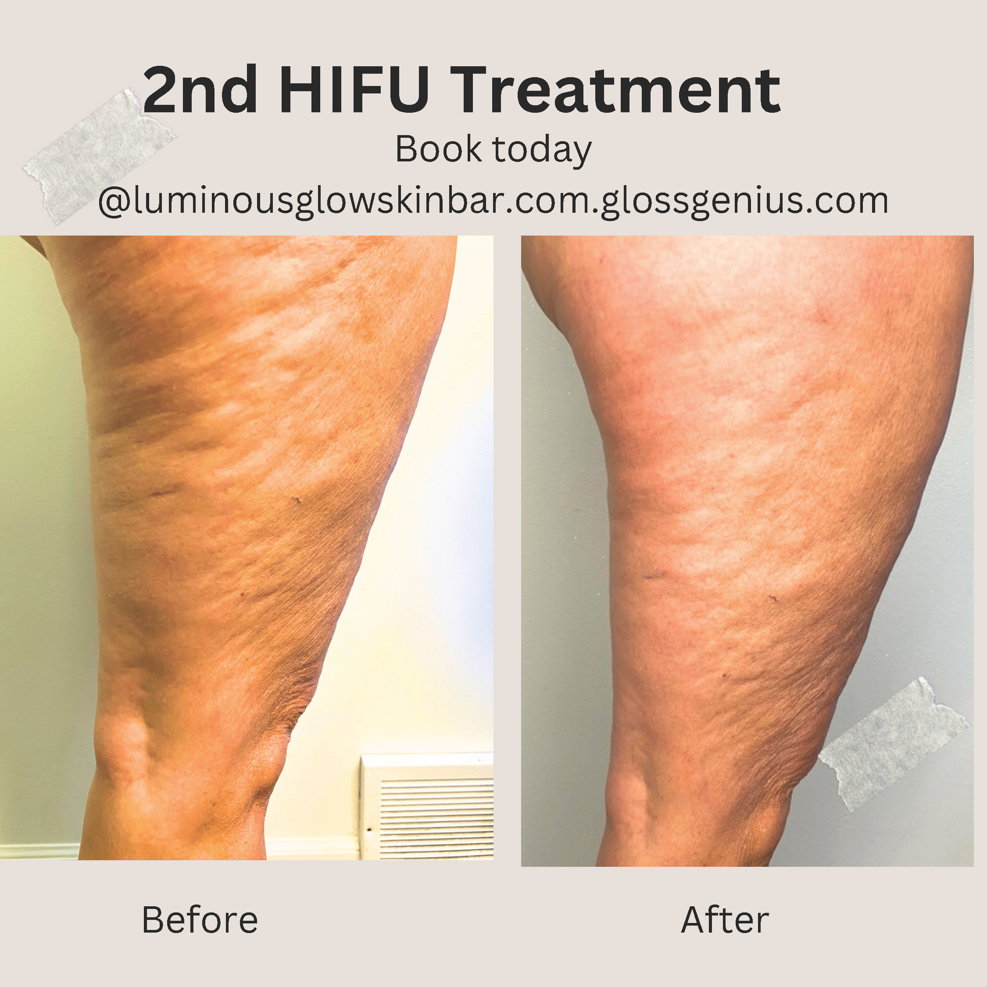 Comparison of a leg with cellulite before and after a HIFU treatment.