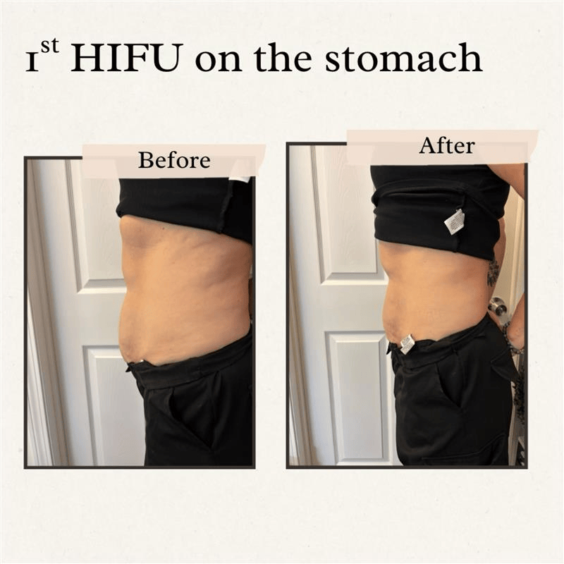Side-by-side comparison of a person's stomach before and after a HIFU treatment. The 