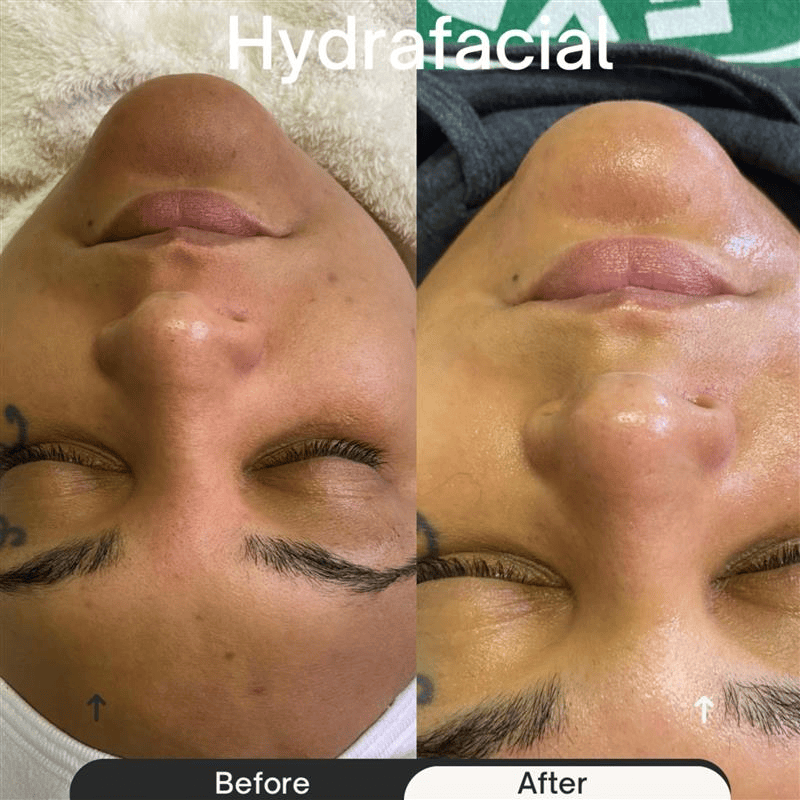 Before-and-after facial comparison. Left: skin before hydrafacial. Right: skin after hydrafacial with smoother texture.