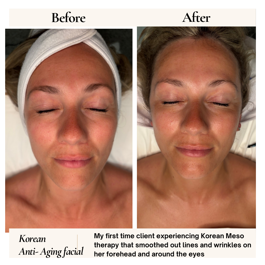 Before and after comparison of a woman's face. Shows results of Korean Meso therapy.