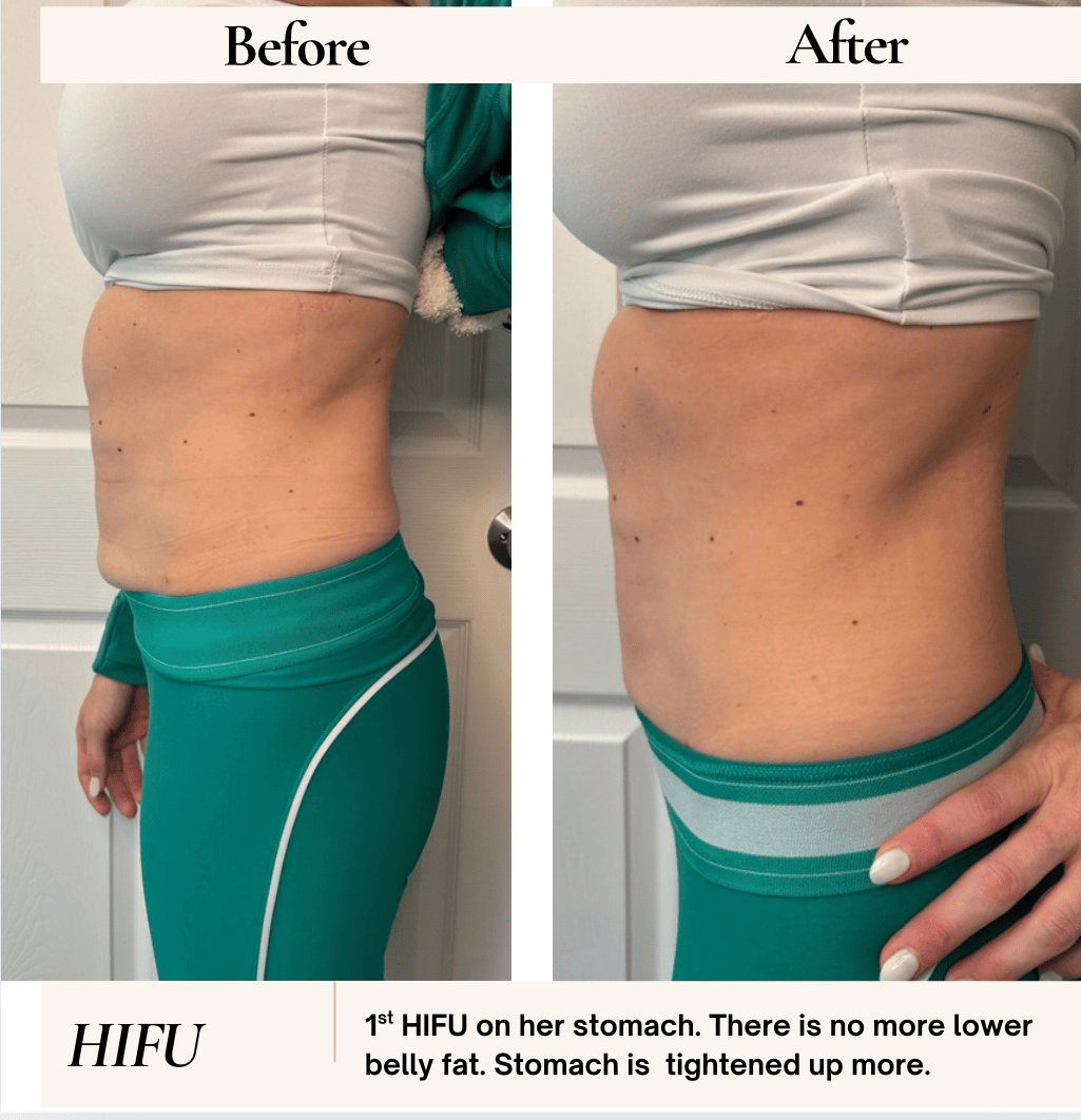 Before and after comparison of abdomen. Skin appears tighter, reducing belly fat after HIFU treatment.