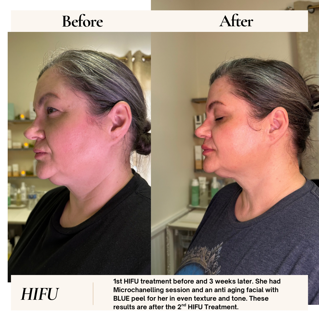 Side-by-side comparison shows woman's face before and after HIFU treatment for skin tightening.