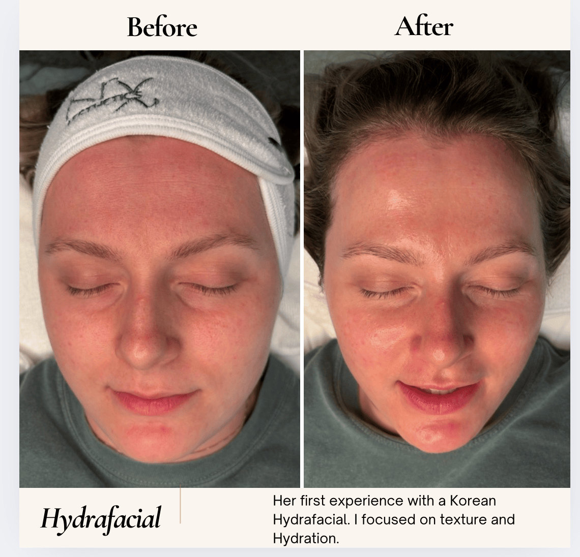 Before/After photos of a woman's face. Before photo: headband, flushed skin. After photo: skin appears smoother, hydrated.