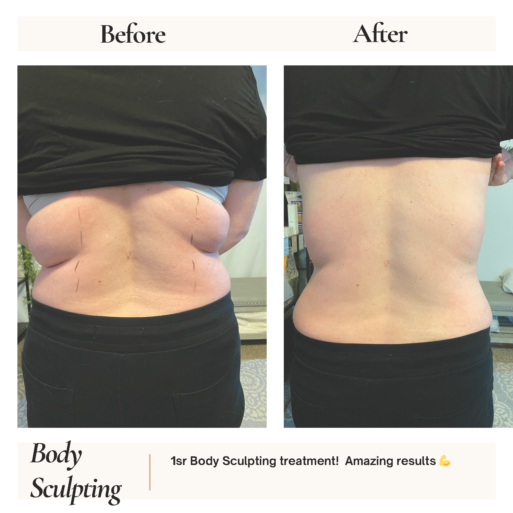 Before and after view of a person's lower back. The 