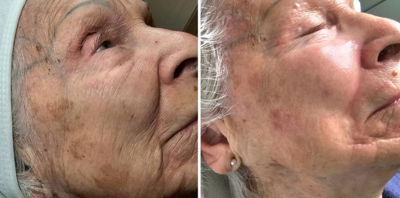 Side-by-side view of an older person's face. Left side: skin with spots and wrinkles. Right side: smoother skin.