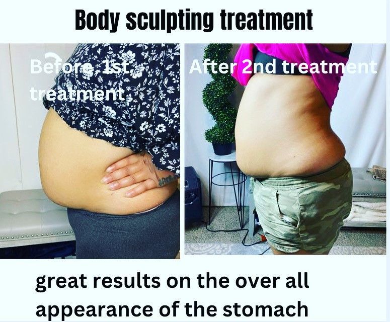 Comparison of a person's stomach before and after body sculpting treatments. The 