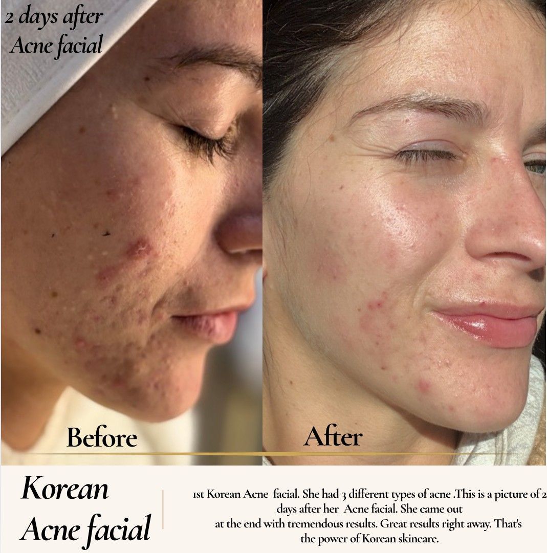 Side-by-side photos: before and after acne facial. The 