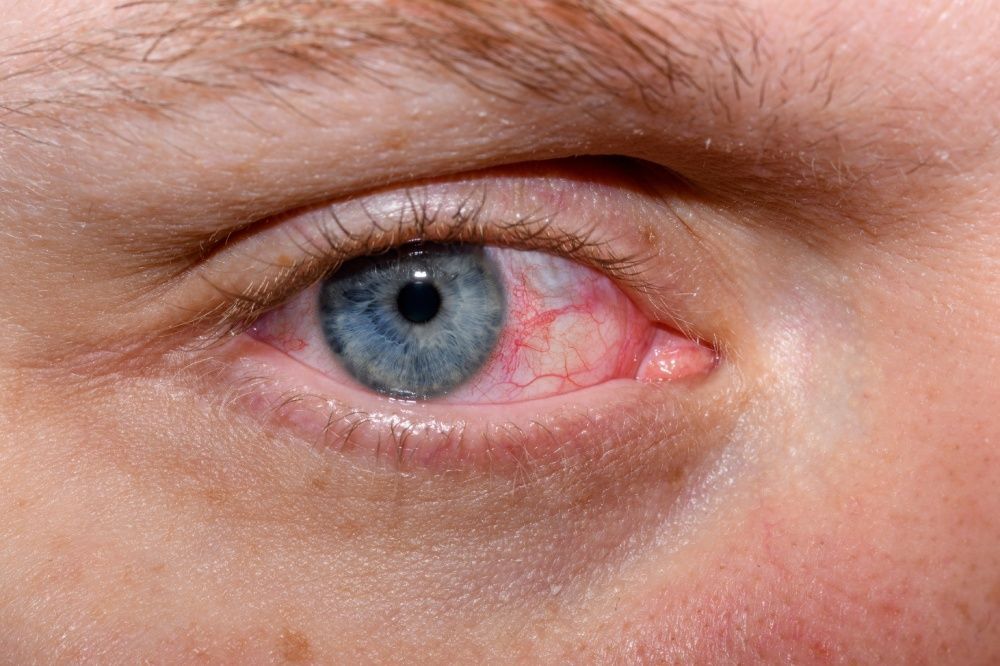 Close-up of a blue eye with red, bloodshot whites.