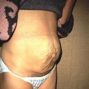 Abdominoplasty Dr. Joel Rein Abdominoplasty Dr. Joel Rein