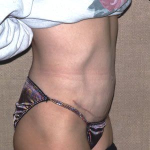 Abdominoplasty Dr. Joel Rein Abdominoplasty Dr. Joel Rein