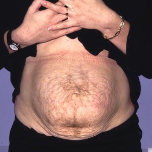 Abdominoplasty Dr. Joel Rein Abdominoplasty Dr. Joel Rein