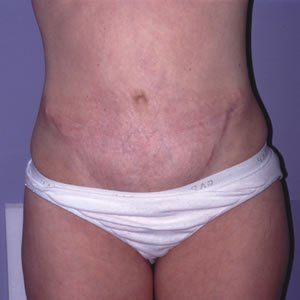 Abdominoplasty Dr. Joel Rein Abdominoplasty Dr. Joel Rein