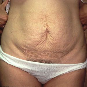 Abdominoplasty Dr. Joel Rein Abdominoplasty Dr. Joel Rein