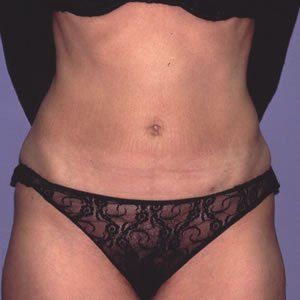 Abdominoplasty Dr. Joel Rein Abdominoplasty Dr. Joel Rein