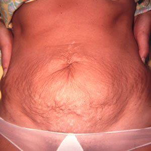 Abdominoplasty Dr. Joel Rein Abdominoplasty Dr. Joel Rein