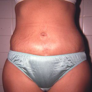 Abdominoplasty Dr. Joel Rein Abdominoplasty Dr. Joel Rein