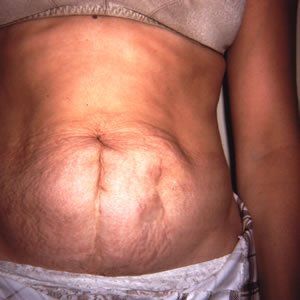 Abdominoplasty Dr. Joel Rein Abdominoplasty Dr. Joel Rein