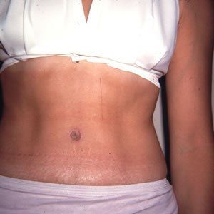 Abdominoplasty Dr. Joel Rein
