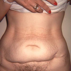 Abdominoplasty Dr. Joel Rein Abdominoplasty Dr. Joel Rein