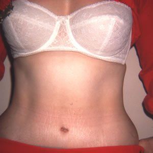 Abdominoplasty Dr. Joel Rein Abdominoplasty Dr. Joel Rein