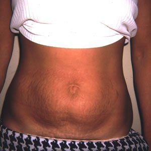 Abdominoplasty Dr. Joel Rein Abdominoplasty Dr. Joel Rein