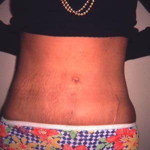 Abdominoplasty Dr. Joel Rein Abdominoplasty Dr. Joel Rein