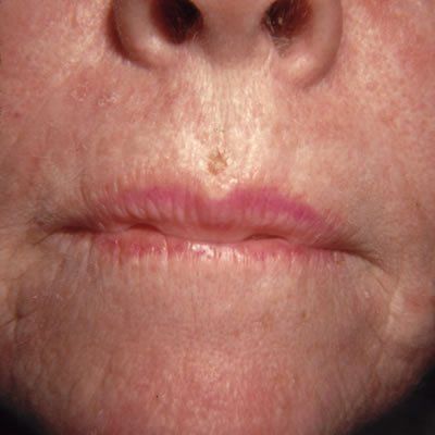 Adjacent Tissue Transfer