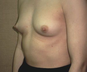 Breast Augmentation Dr. Joel Rein Breast Augmentation Dr. Joel Rein