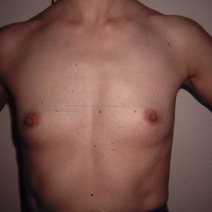 Breast Augmentation Dr. Joel Rein Breast Augmentation Dr. Joel Rein