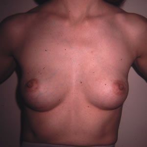 Breast Augmentation Dr. Joel Rein Breast Augmentation Dr. Joel Rein